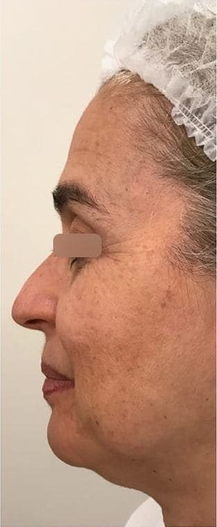 Antes do tratamento com bioestimulador de colágeno, contorno do rosto