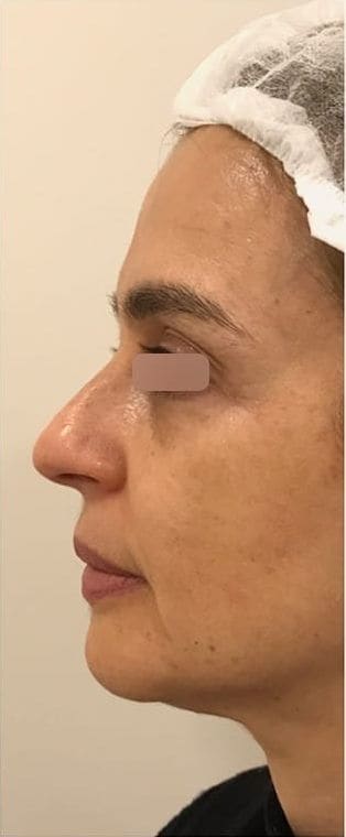 Depois do tratamento com bioestimulador de colágeno, contorno do rosto