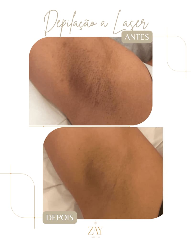Antes e depois da depilação a laser na axila, paciente real da Zay